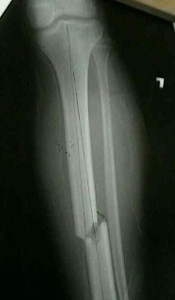 fracture1290784269